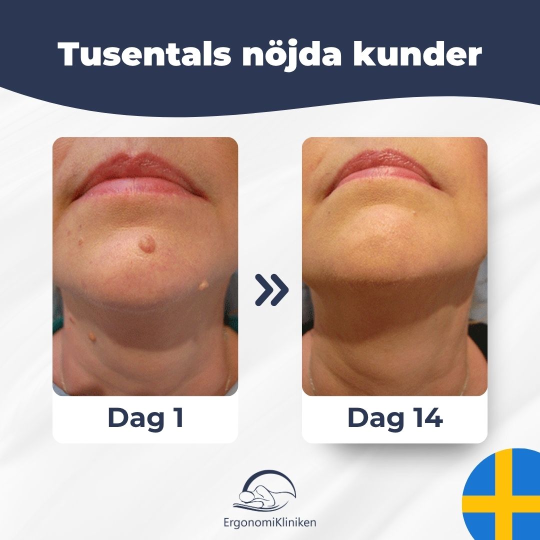 Skin Tag Remover