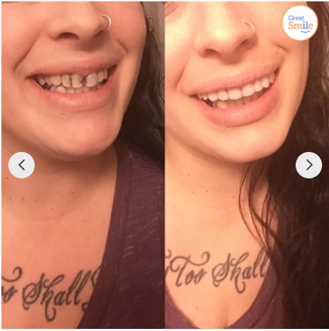 Snap-On Dentures | 1+1 FREE!