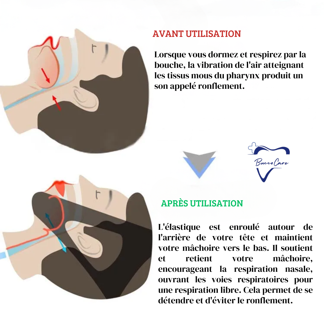 Anti-Snoring Device - Sleep Apnea - Night Comfort