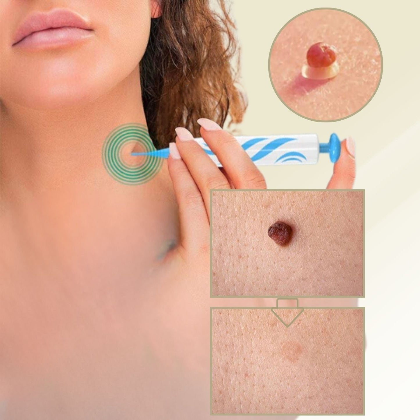 DermaLinx Wart Remover | Pain-Free Removal of Warts & Moles | For Home | Without Surgery