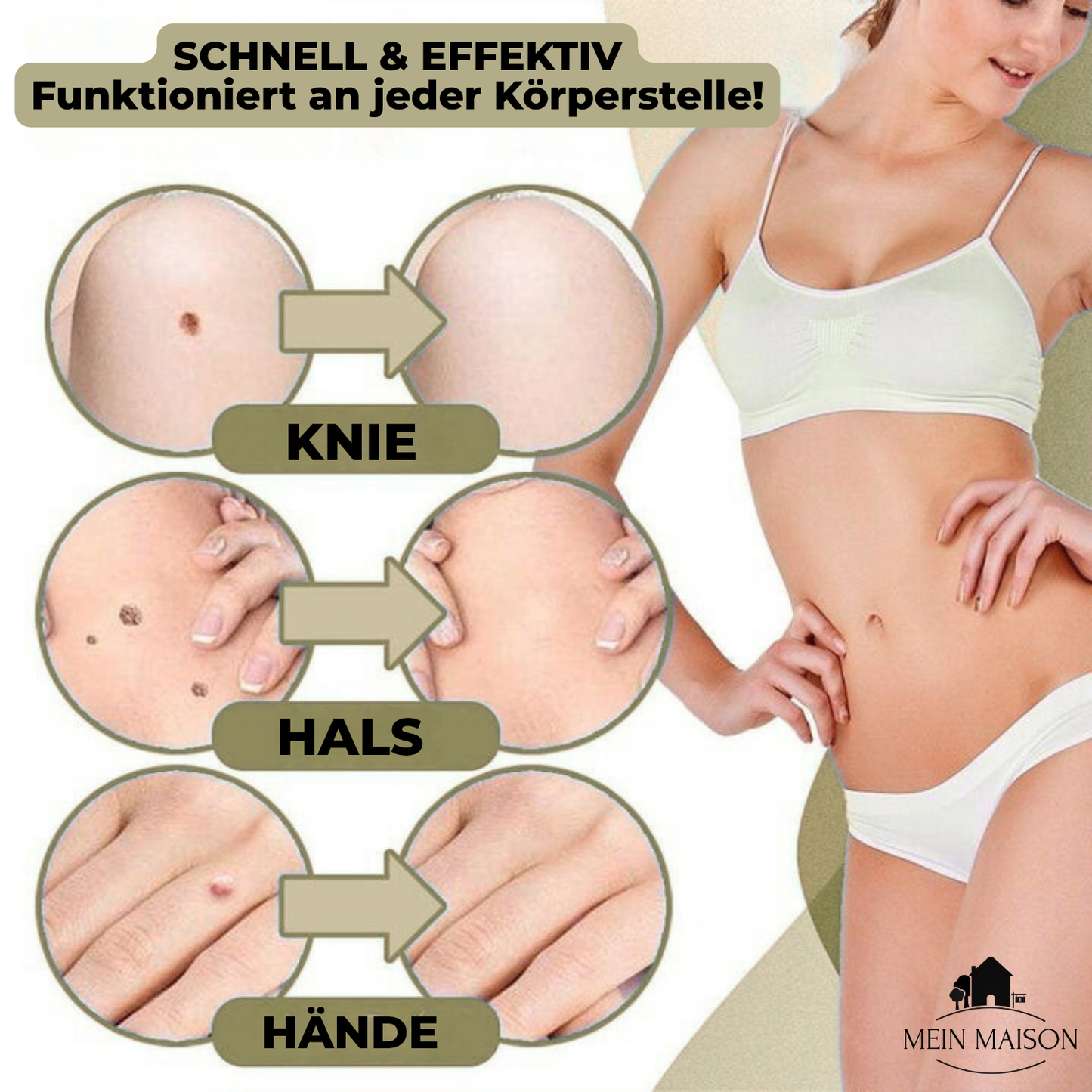 DermaLinx Wart Remover | Pain-Free Removal of Warts & Moles | For Home | Without Surgery