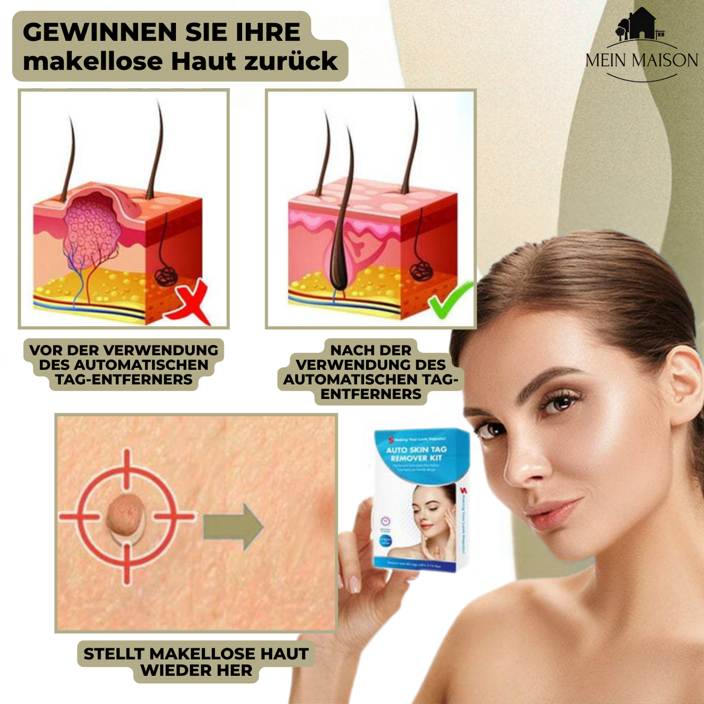 DermaLinx Wart Remover | Pain-Free Removal of Warts & Moles | For Home | Without Surgery