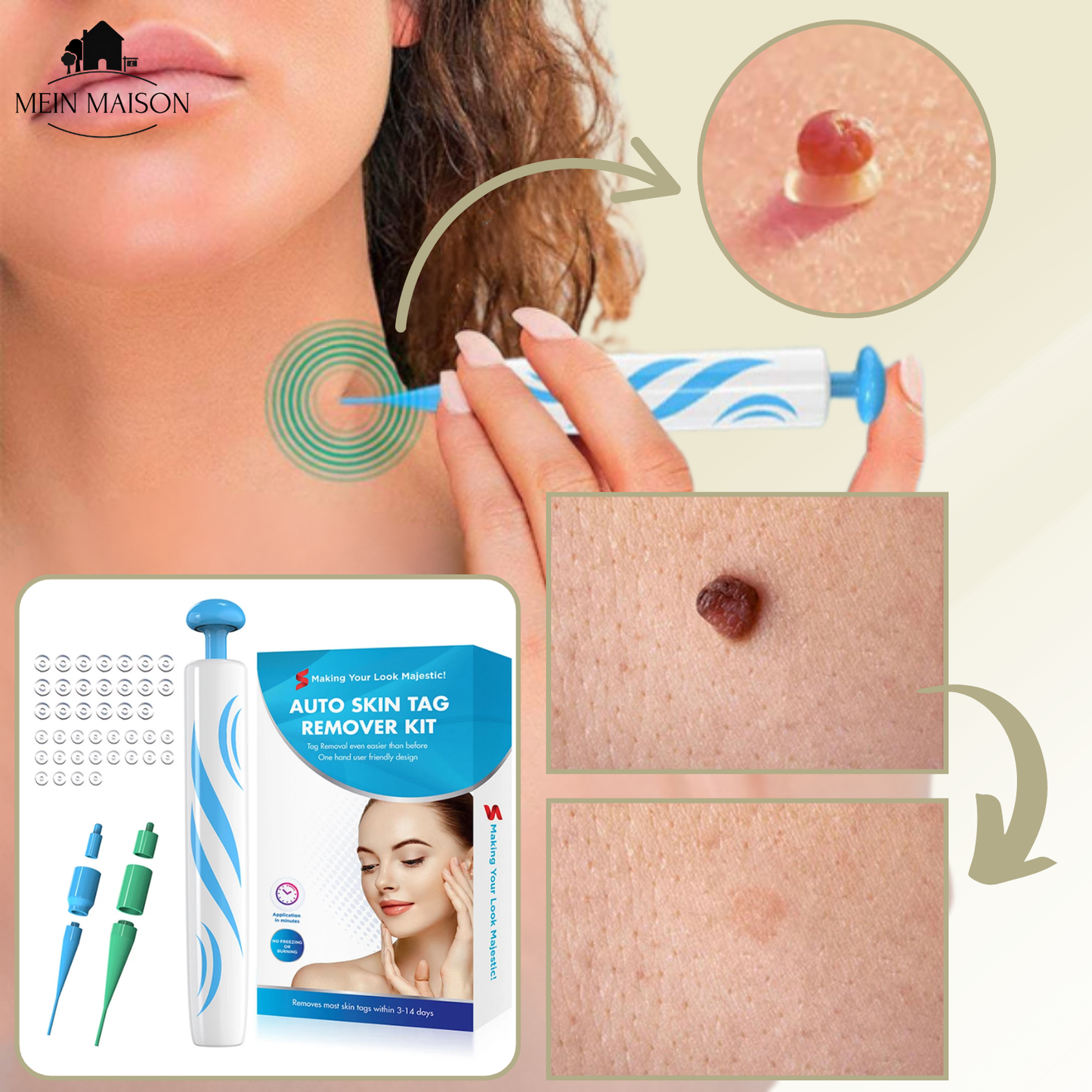 DermaLinx Wart Remover | Pain-Free Removal of Warts & Moles | For Home | Without Surgery