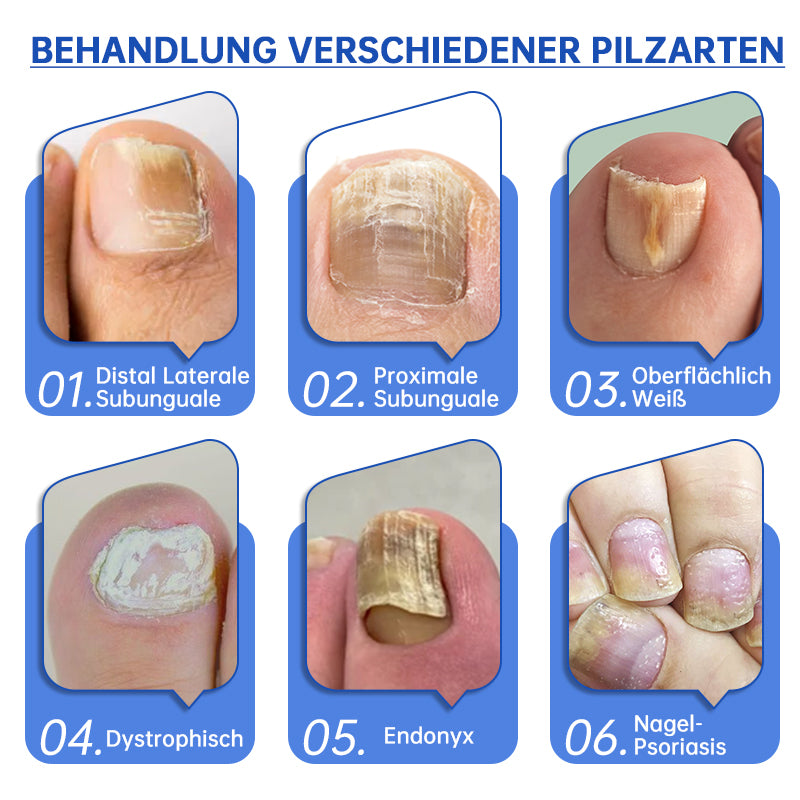 NailCure™ - Laser Treatment Solution for Nail Fungus (50% DISCOUNT)