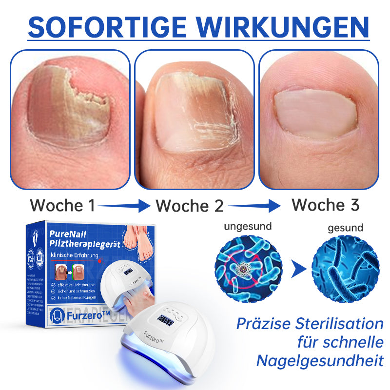 NailCure™ - Laser Treatment Solution for Nail Fungus (50% DISCOUNT)