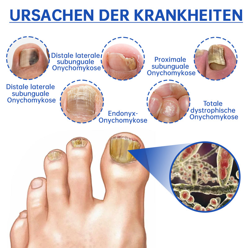 NailCure™ - Laser Treatment Solution for Nail Fungus (50% DISCOUNT)