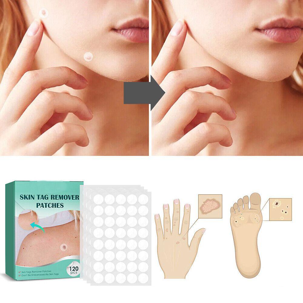 Patch for the removal of spots and warts