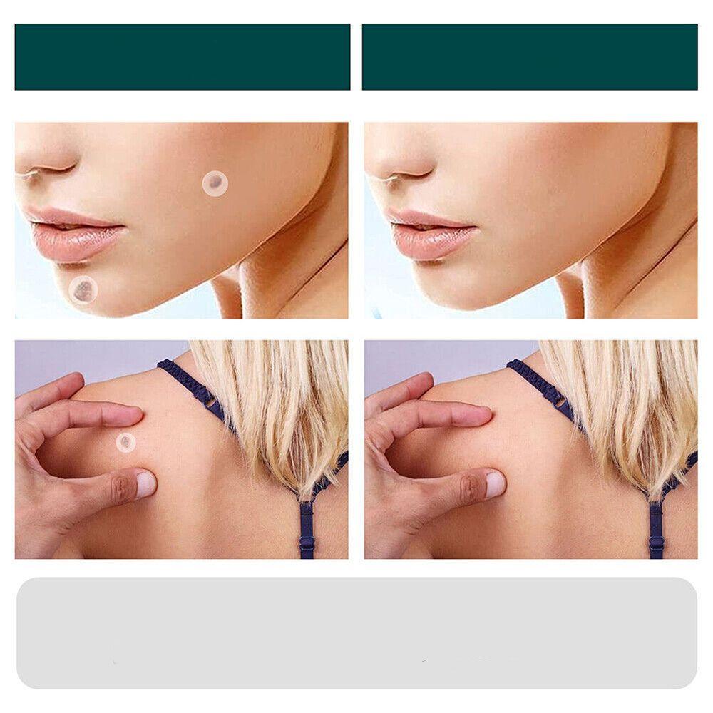 Patch for the removal of spots and warts
