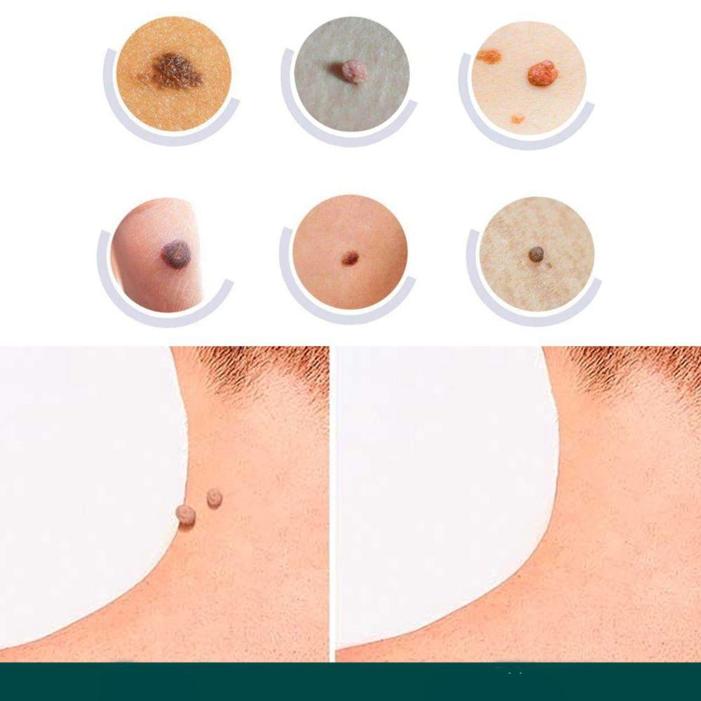Patch for the removal of spots and warts