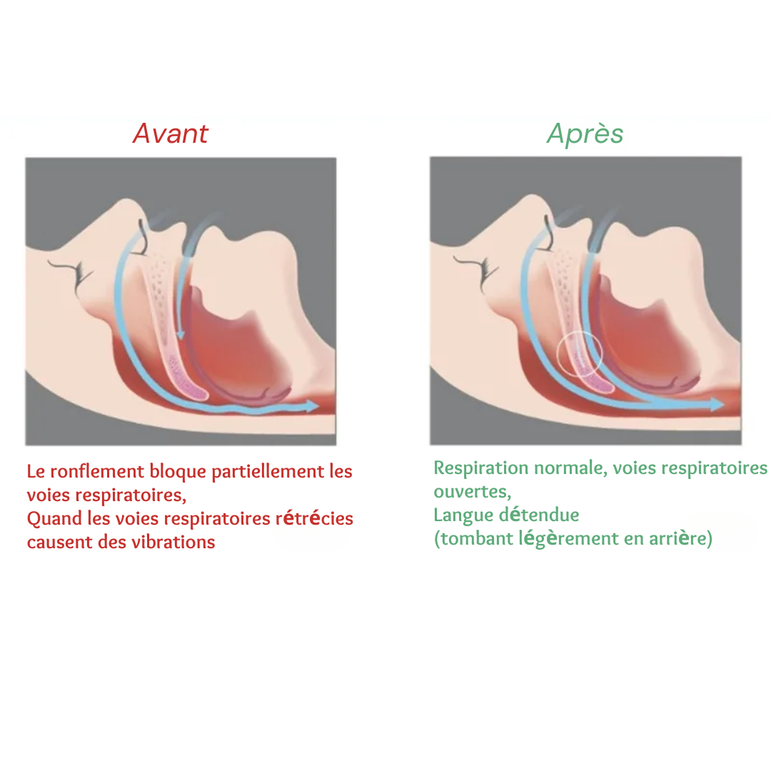 Premium Anti-Snoring Orthosis: Comfortable Sleep Splint
