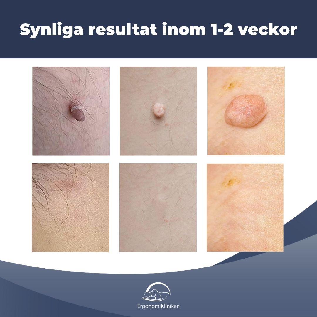 Skin Tag Remover