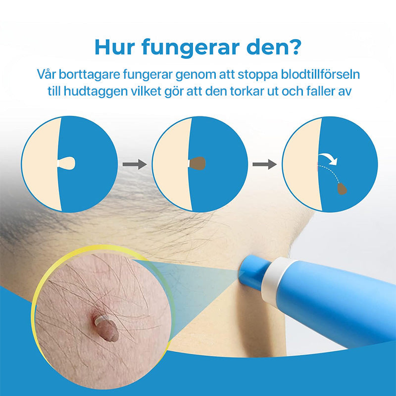 Skin Tag Remover