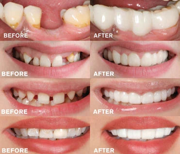 Snap-On Dentures | 1+1 FREE!