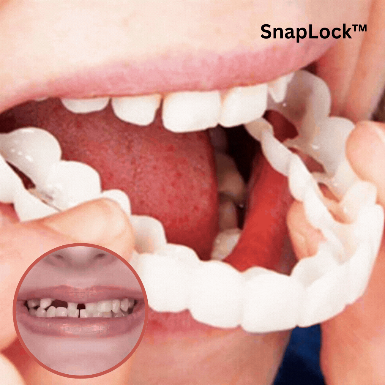 SnapLock Dentures | Secure Comfort for Your Smile