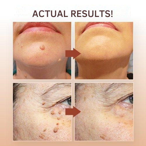 Wart Remover | Precision Applicator for Spot Treatment | Plant-Based Care Formula
