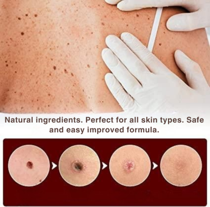 Wart Remover | Precision Applicator for Spot Treatment | Plant-Based Care Formula
