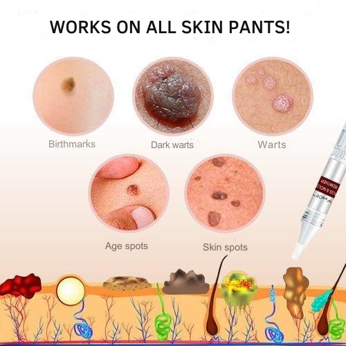 Wart Remover | Precision Applicator for Spot Treatment | Plant-Based Care Formula