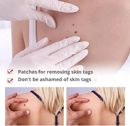 Wart Remover | Precision Applicator for Spot Treatment | Plant-Based Care Formula